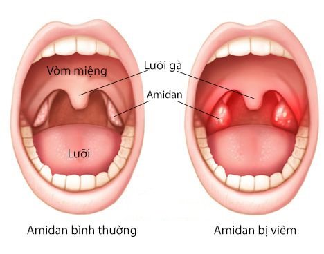 Trẻ bị viêm amidan cấp cần lưu ý gì khi giao mùa?