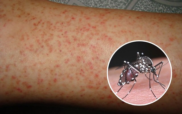 Bị sốt xuất huyết, cần thực hiện nguyên tắc