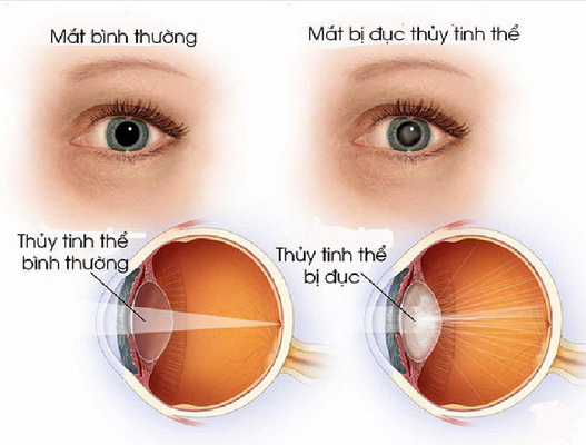 Những triệu chứng bất thường của đôi mắt ai cũng nên biết